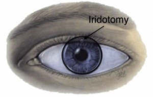 iridotomy