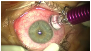 Trans-scleral cyclophotocoagulation using the Iridex micropulse laser.