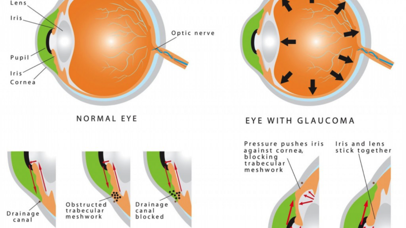 types-of-glaucoma